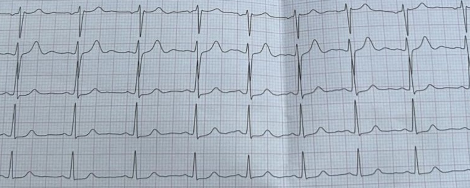 Brauche ich vor meinem ersten Marathon ein Belastungs-EKG?